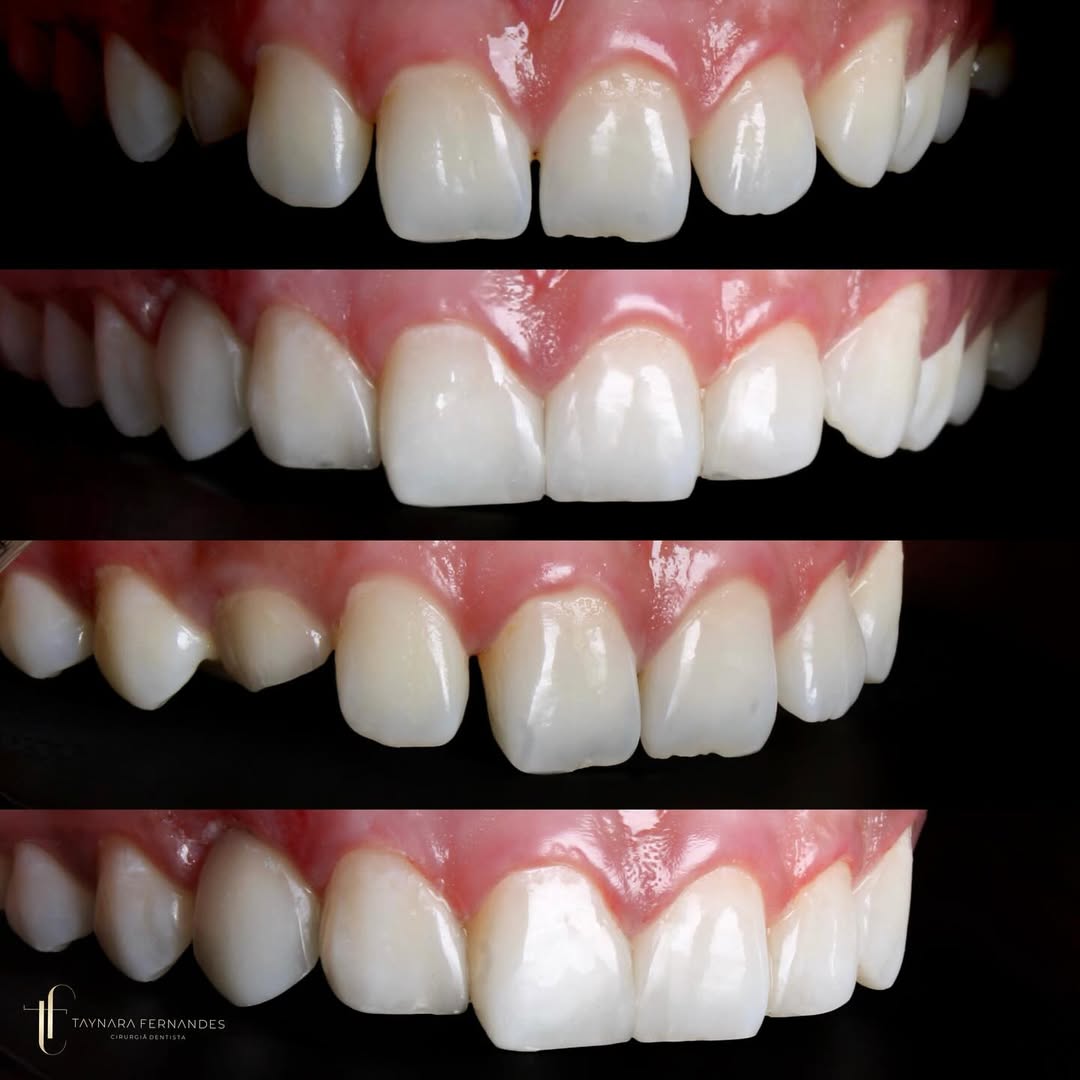 Correção de Diastemas (antes e depois)